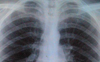 Can physiotherapy help with respiratory conditions?