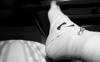 Can physiotherapy help with my ankle injury?