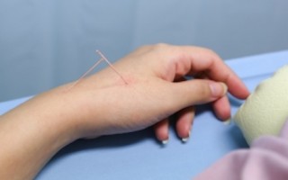 Acupuncture