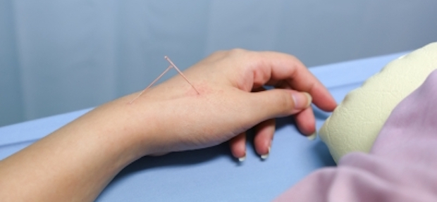 Acupuncture