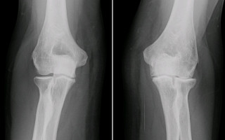 Elbow arthritis