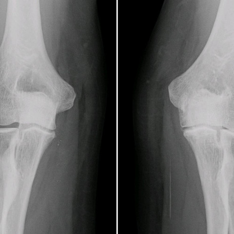 Elbow arthritis