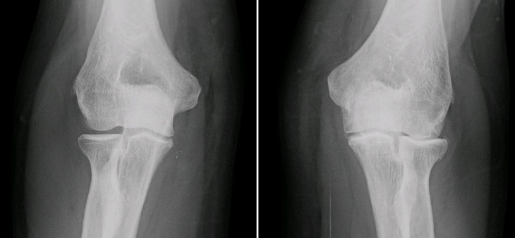 Elbow arthritis Elbow arthritis